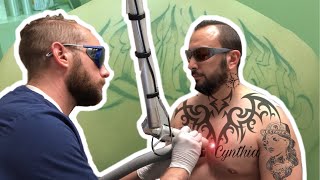 LASER TATTOO REMOVAL  15 Sessions Later [upl. by Rozek]