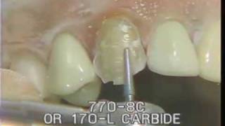 Maxillary Cuspid Preparation for a Porcelain Fused to Gold Crown [upl. by Eiznekcam]