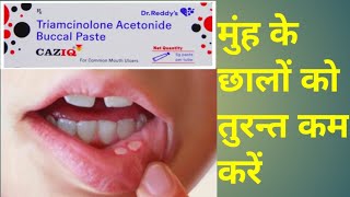 Caziq buccal paste uses in HindiMouth Ulcer Paste [upl. by Janeva701]