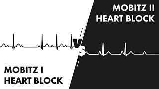 Mobitz Type I vs Type II Second Degree Heart Block [upl. by Milissa]