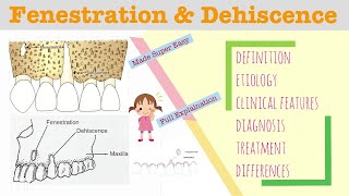 Fenestration and Dehiscence I Periodontology Lectures [upl. by Mandle593]