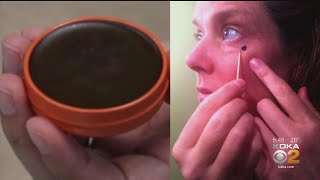 Doctors Warn About The Use Of Black Salve As A Cure For Skin Cancer [upl. by Airdua776]