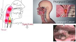 Throat cancer  Symptoms causes and Treatment Laryngeal Cancer and Pharyngeal Cancer [upl. by Anidene]