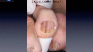 Nail pigmentation beginners level by Dr Luc Thomas [upl. by Hannie]