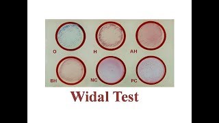 Widal Test  Slide and Tube Full Procedure [upl. by Sueahccaz929]