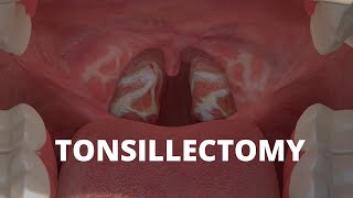 What is Tonsillectomy [upl. by Ahsa]