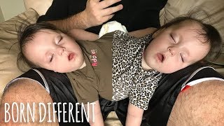 Conjoined Twins Are A Medical Miracle  BORN DIFFERENT [upl. by Ennaul]