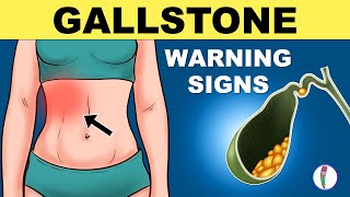 Gallbladder Stones Symptoms  Cholelithiasis  Gallstones Symptoms  Gallstones Warning Signs [upl. by Elum729]