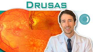 O que são drusas Drusas e a degeneração macular [upl. by Tj]