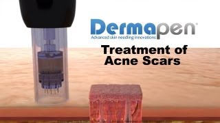 MicroNeedling for Acne Scars  Dermapen® Treatment [upl. by Cohen]