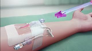 PIVO™ Needlefree Blood Collection Device Straight IV Catheter System [upl. by Karlens463]