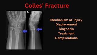 Colles fracture Diagnosis Dinner fork deformity Xray findings Reduction amp Treatment [upl. by Decrem]