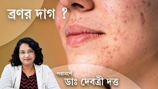 অ্যাকনে মার্কস সারাবেন কিভাবে  Dermatologist suggests treatment for Acne Marks [upl. by Mecke]