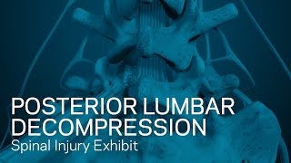 Posterior Lumbar Decompression  Spinal Injury Animation [upl. by Sello]