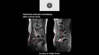 MRI of the Hip Part 4 – Hip Trauma [upl. by Enyalb]