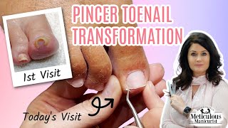 Pincer Ingrown Toenail Transformation How to Pedicure [upl. by Yesnik]