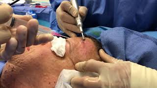 Surgeon Explains Dermabrasion for Cutaneous Neurofibromas [upl. by Fortin]