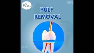 Root canal treatment [upl. by Eelrahs]