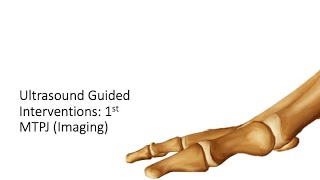 ultrasound Guided Interventions 1st MTPJ Imaging fyp sport sports sportsmedicine [upl. by Fawne]