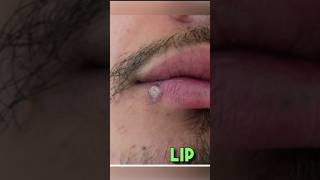 Behind these common skin lesions clinical Skin [upl. by Gwenn]