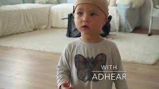 MEDELs ADHEAR Hearing with Microtia and Atresia [upl. by Lenette984]