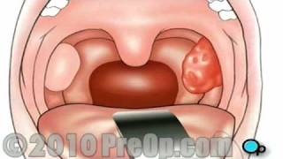 Tonsillectomy Surgery PreOp® Patient Education Feature [upl. by Schilt]