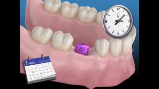 Implantes Dentales IMETI  Proceso Quirúrgico en la colocación de un implante [upl. by Melac]