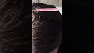 How I get rid of dandruff using a scalp massage brush [upl. by Cralg13]