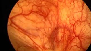 Endoscopic view of interstitial cystitis bladder during low pressure cystoscopy [upl. by Nnaeiluj735]