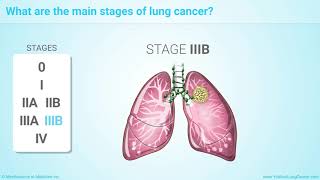 Lung Cancer Stages Explained Shorts [upl. by Asserac]