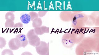 Malaria blood smear Plasmodium falciparum vs vivax headphone ring trophozoite banana gametocyte [upl. by Krystalle]