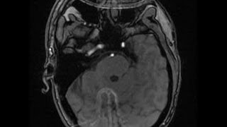 MRT nach Schlaganfall  MRI after ischemic stroke 2 [upl. by Brewster]