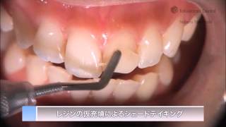 ESTELITE ASTERIA Clinical Guide EN  Tokuyama Dental [upl. by Eissej]