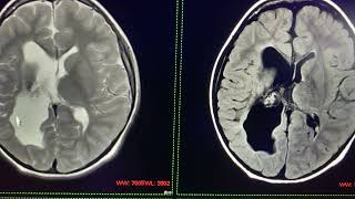 Retraso psicomotriz relacionado con Malformación cerebral secundaria a infarto hemorragico [upl. by Davy]