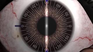 Auroflex Toric Marking amp Implantation guide [upl. by Melessa]