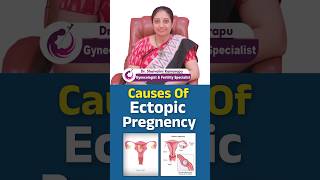 Causes of Ectopic Pregnancy Understanding the Risks and Prevention  shorts ectopicpregnancy [upl. by Aihsetal522]