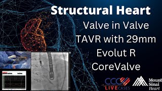 Valve in Valve TAVR with 29mm Evolut R CoreValve  January 8 2019 [upl. by Reagan]