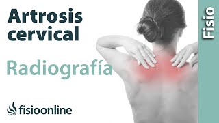 Artrosis cervical  Qué es y cómo se diagnostica en radiografías [upl. by Darcie]