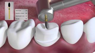 Crown preparation tutorial by Prof Brian Millar [upl. by Files]