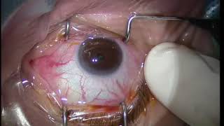 Lucentis Intravitreal Injection Technique for maculopathy [upl. by Eintruoc912]