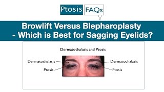 Browlift Versus Blepharoplasty  Which is Best for Sagging Eyelids [upl. by Ahsieni25]