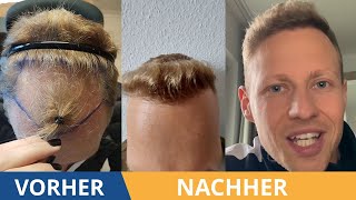 Der Verlauf der Haartransplantation  Alle Vorher Nachher Bilder [upl. by Adnowal]