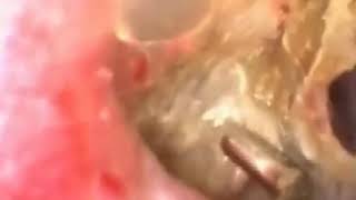 Acne treatment Big Blackhead on ear 2017blackhead in ear removal [upl. by Anilas898]