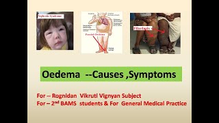 Mastering Oedema –Types amp Causes Symptoms l Oedema Pathology l Rognidan l 2nd BAMS l शोथ l Ayurveda [upl. by Estelle5]