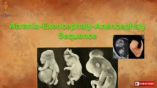 AcraniaExencephalyAnencephaly Sequence [upl. by Innig401]