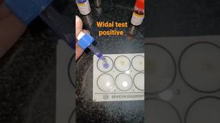 Serological practical WIDAL test typhoidfever trending practical pathology shorts [upl. by Eaver47]