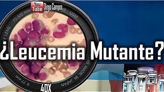 Caso clinico Nº1 Leucemia mieloide CronicaLMC [upl. by Alilahk5]