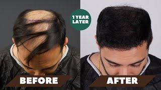 My 1 Year Hair Transplant Journey  Before amp After Trust The Process [upl. by Nilpik]