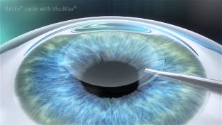 Carl Zeiss Meditec  Visumax  RELEX SMILE [upl. by Leiso597]