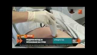 Как се махат стрии  Stretch marks striae removing treatment in Hill Clinic Sofia Bulgaria [upl. by Jedthus]